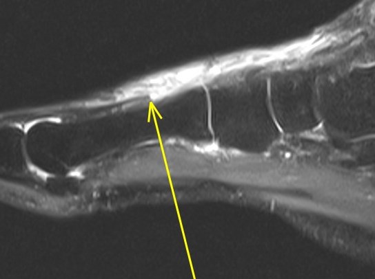 Figure 2 for case Extensor hallucis longus tendon ( RID3188 ) laceration